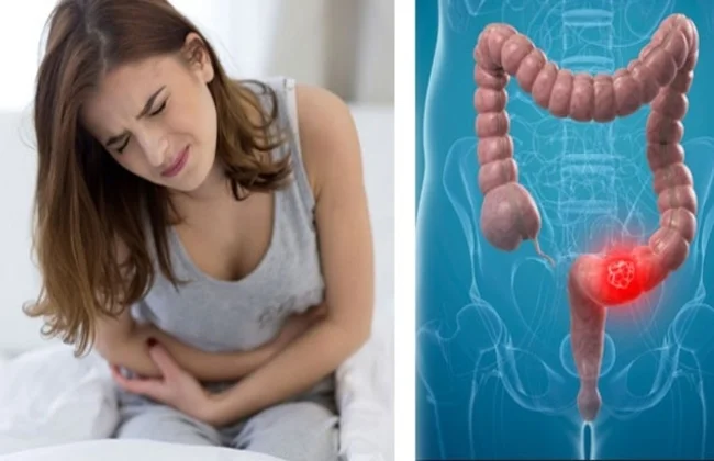 الكوبروليت أو البراز المتحجر : الأعراض الرئيسية والعلاج